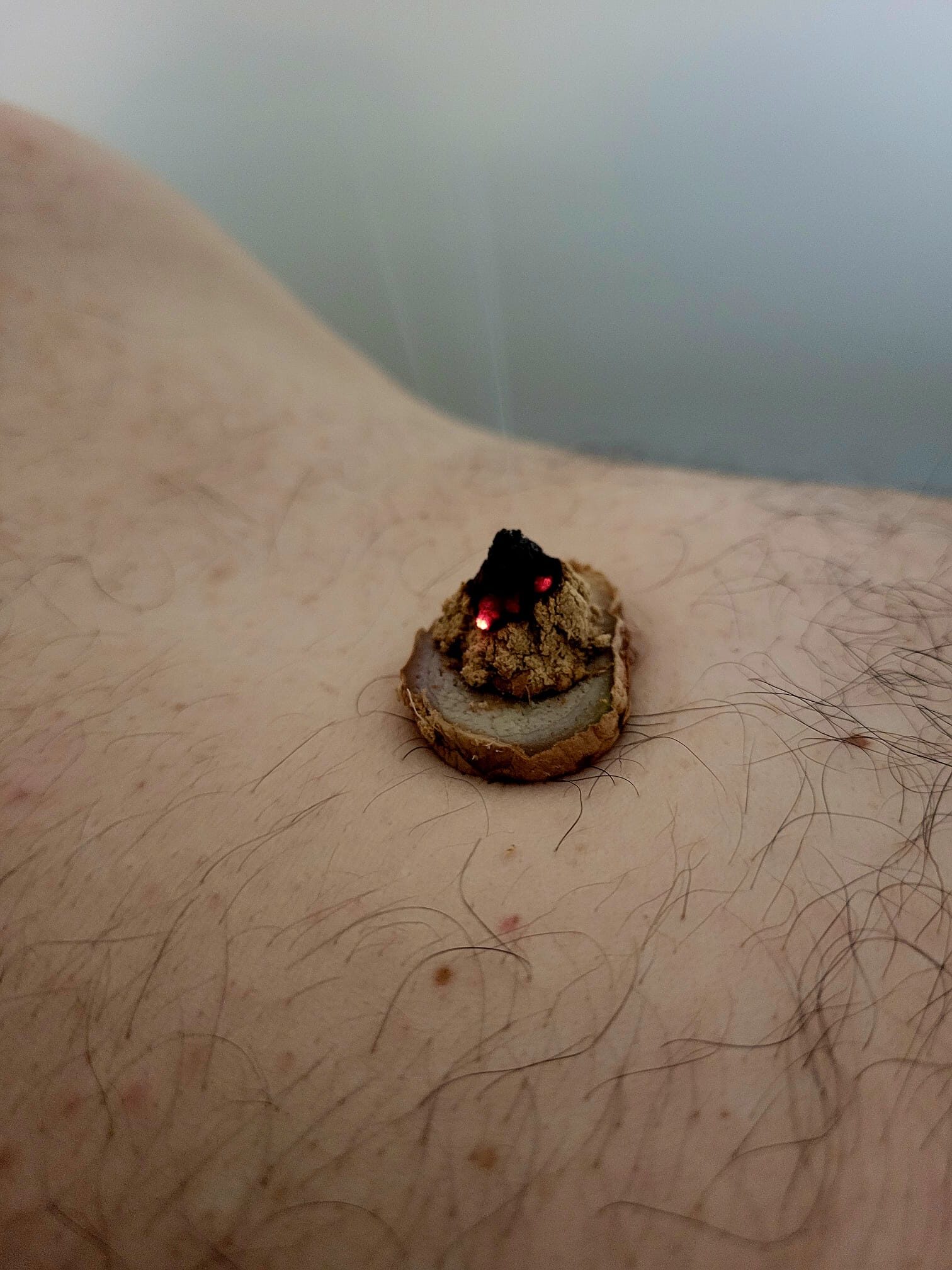 Cône de moxa sur gingembre